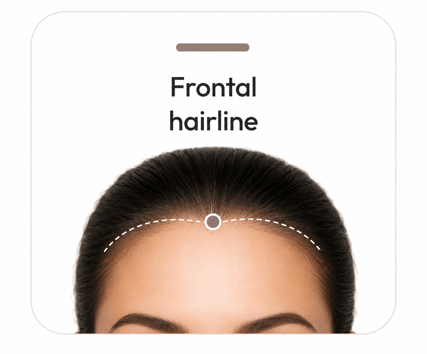 Front view of a head with the frontal hairline marked as the first scalp-magnification assessment point.