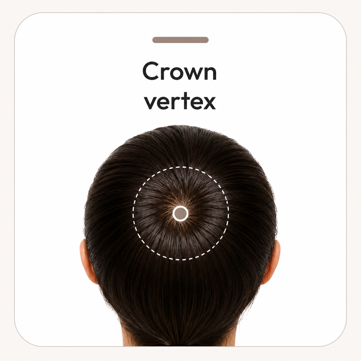 Upper rear view of a head with the crown or vertex marked as the third scalp-magnification assessment point.