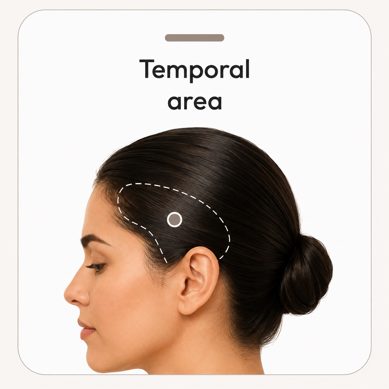 Side view of a head with the temporal scalp marked as the fourth scalp-magnification assessment point.
