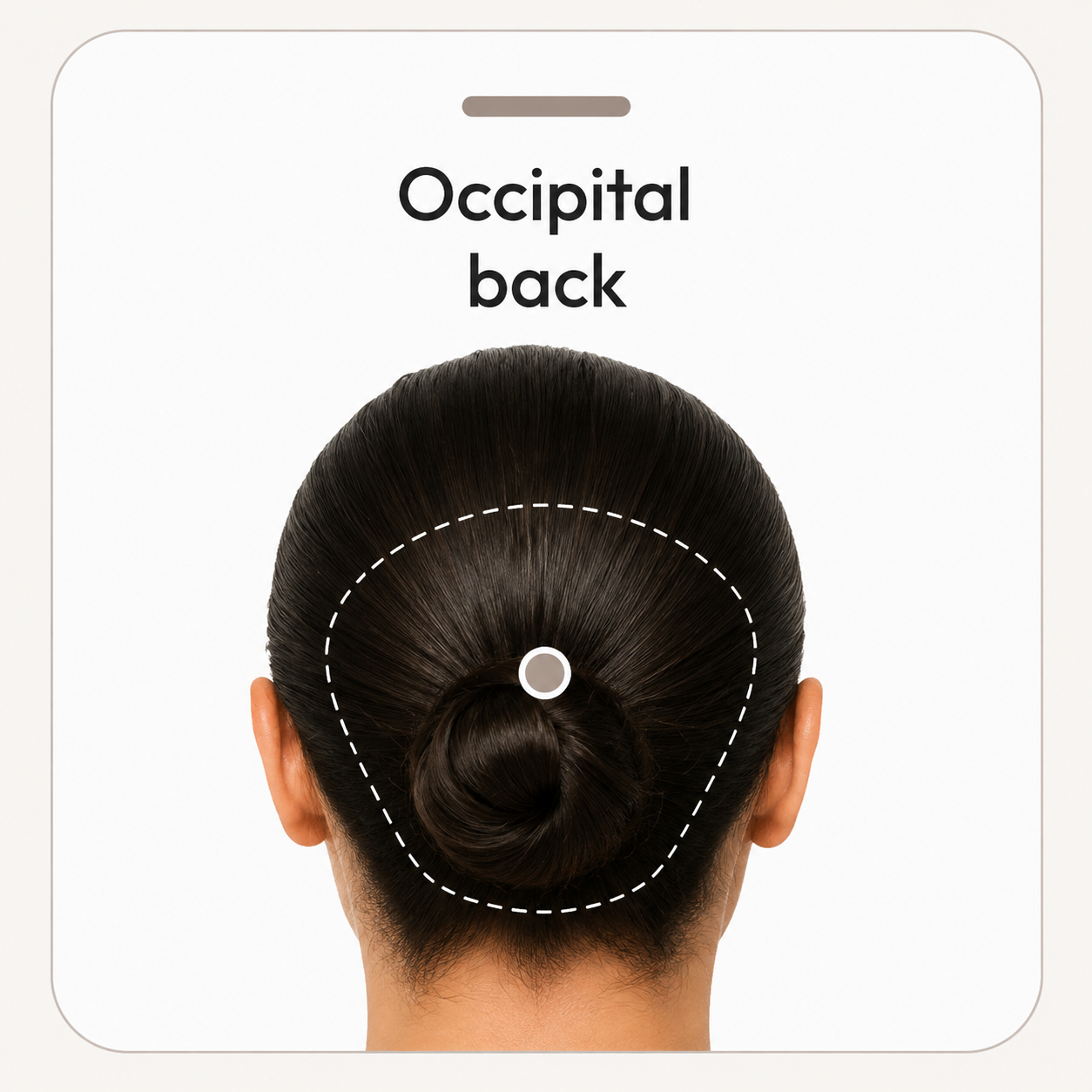 Back view of a head with the occipital scalp marked as the fifth scalp-magnification assessment point.