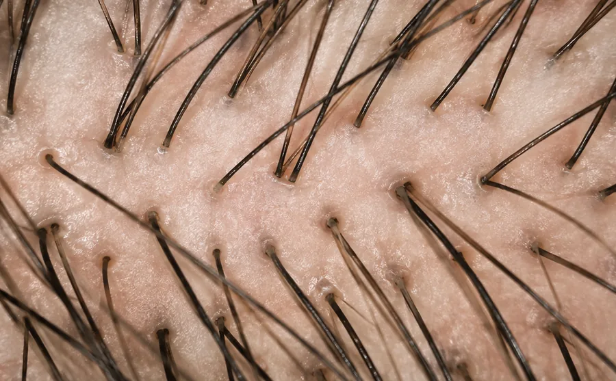 Illustrative magnified scalp view with visible hair shafts, relatively clear follicular openings, and minimal obvious surface scale or residue.