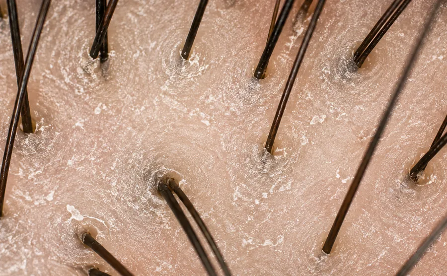 Illustrative magnified scalp view showing a matte-appearing surface with fine loose light-colored scale around hair shafts.