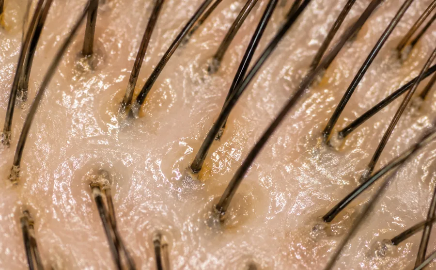 Illustrative magnified scalp view showing diffuse shine and yellow-white material around several hair shafts and follicular openings.