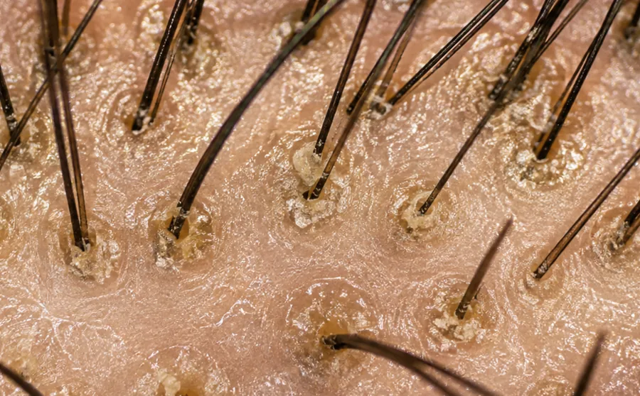 Illustrative magnified scalp view showing visible surface coating and light-colored material around multiple hair shafts and follicular openings.