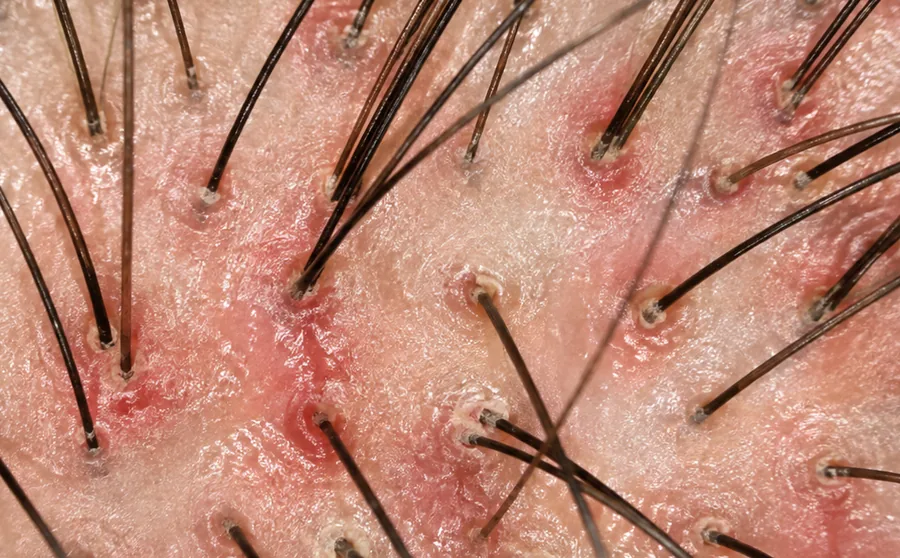 Illustrative magnified scalp view showing localized color variation around several hair shafts and follicular openings.