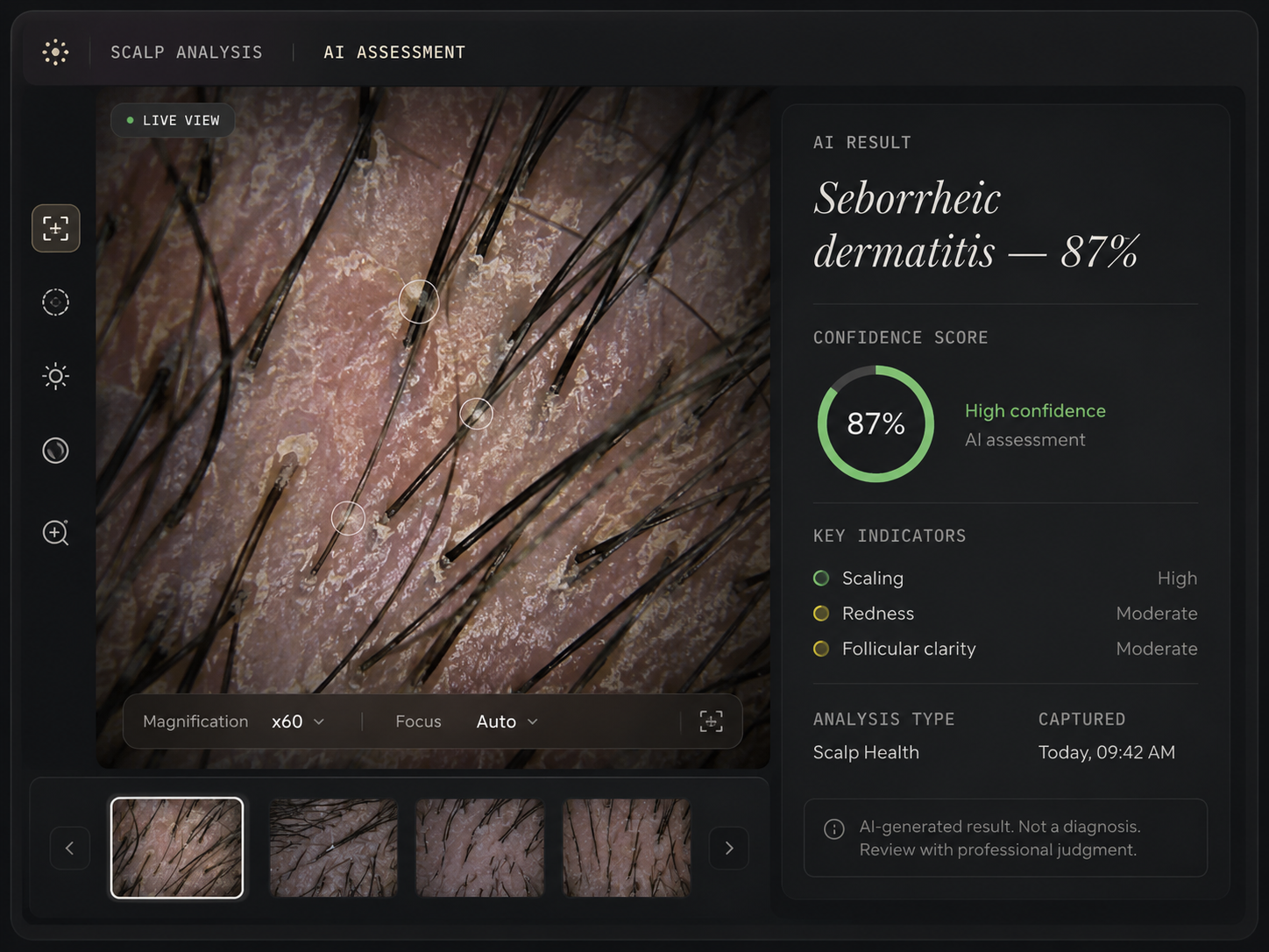 Example AI-assisted scalp-analysis interface displaying a condition label and an 87 percent confidence score.